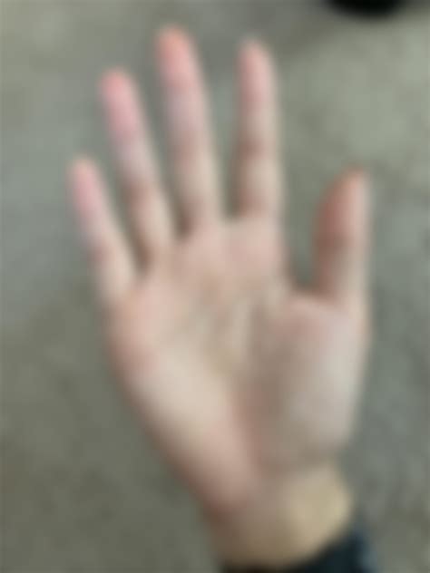 Anyone else’s hands peeling b/c of excessive hand sanitizer usage? No