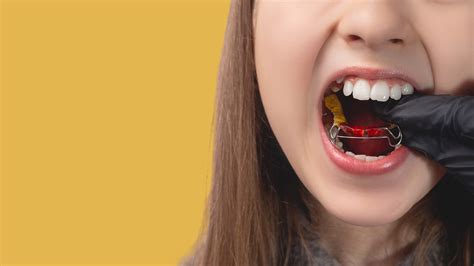 Inman Aligner Loughborough | Leicestershire