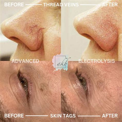 Advanced Electrolysis | Treatments at AKB Aesthetics