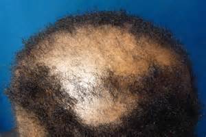 Central centrifugal cicatricial alopecia (CCCA): Causes, symptoms, and