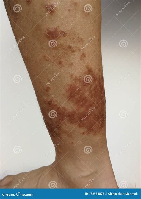 Junge Hat Chronische Hautausschlag Auf Die Haut Allergische