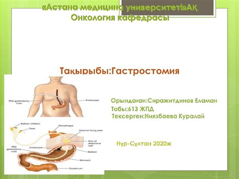 Гастростомия. Гастростомия жасауға - презентация онлайн