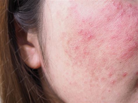 Premium Photo | Red rash on young woman face, Itchy and allergic skin