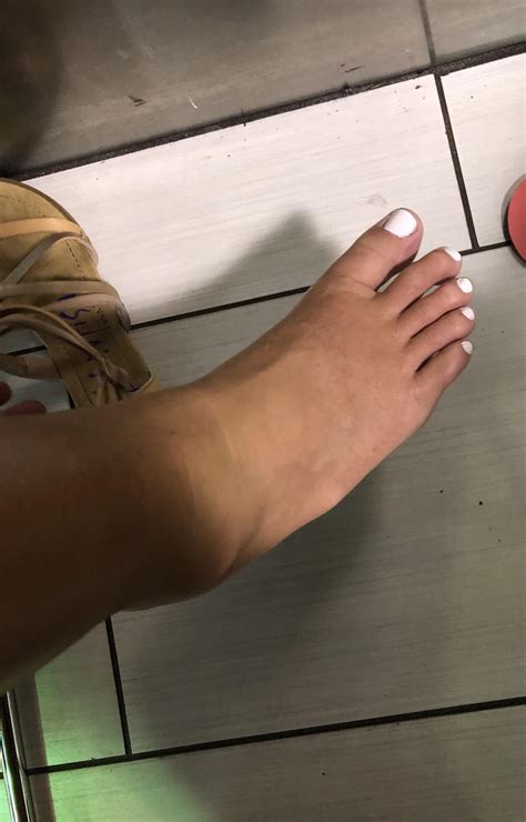 Rolled her bad ankle on uneven sidewalk and takes her sandal off in