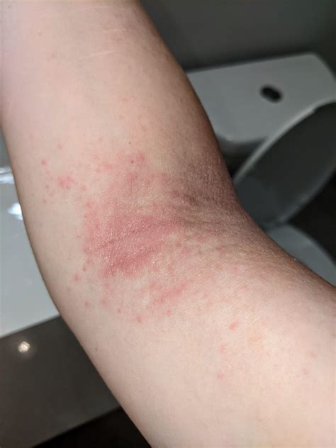 Tiny red bumps? : r/eczema