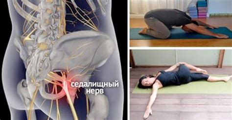 8 простых упражнений, которые помогут избавиться от защемления ...