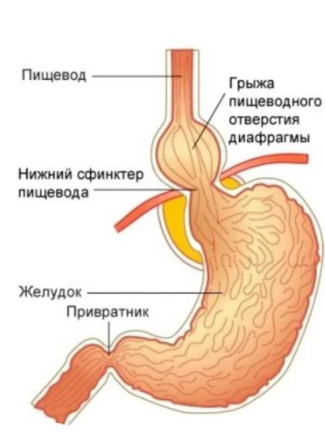 Грыжа пищеводного отверстия диафрагмы | Игорь Петрович Костюк | Дзен