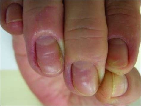 paronychia treatment  ayurveda