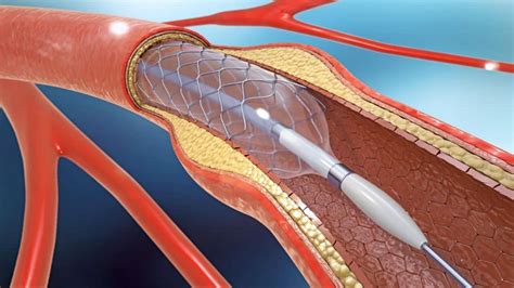 Stent Placement | Imaging And Interventional Specialists