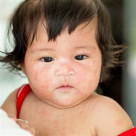 Roseola Rash Pictures Symptoms Causes Treatment Home - vrogue.co
