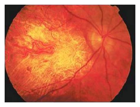 hard drusen   temporal side  macula  patient  dry armd