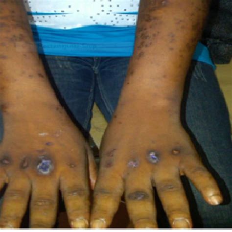 Showing superficial partially healed blisters on both upperlimbs ...