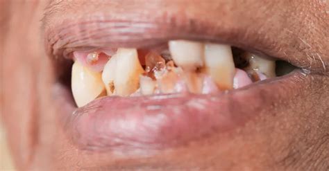 tooth   tooth     tooth average joe weekly