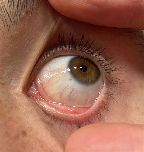 Does this look like jaundice? : r/medical