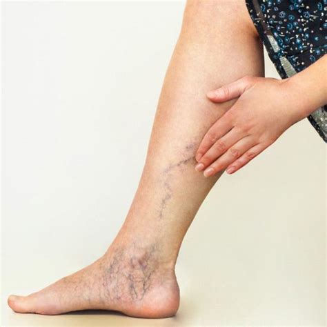 Laser Varicose Vein Surgery Procedure in Ludhiana, Punjab