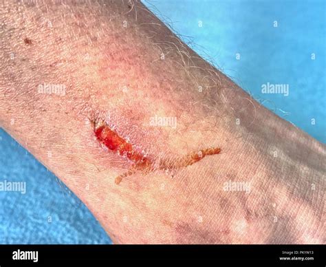 Skin wound. Wet Abrasion. Deep wound on the skin in detail Stock Photo ...