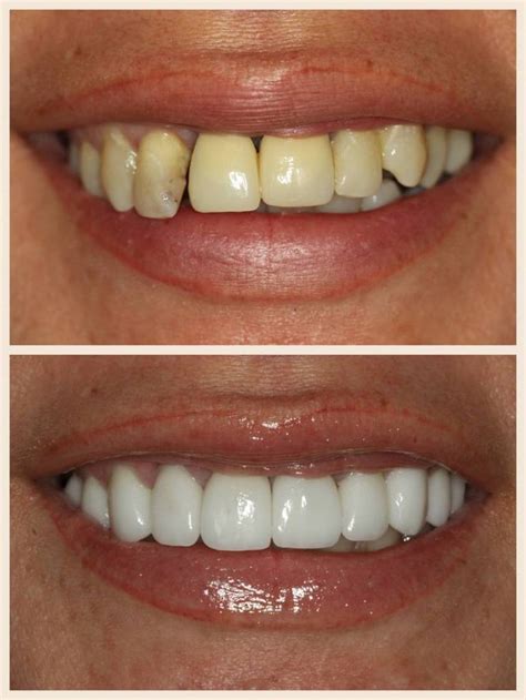 best veneers near me - Letitia Hobbs
