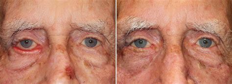 Right lower lid ectropion repair - Blepharoplasty & Eyelid Surgery | Dr ...
