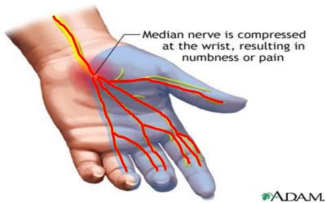 Median nerve injuries