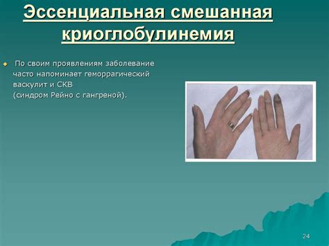 Системные васкулиты - презентация онлайн
