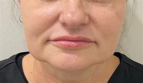 "Boxer Dog" Face - Getting Rid Of Saggy Jowls | Premier Clinic
