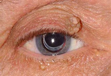 Skin tags on eyelids images - nerymaxx
