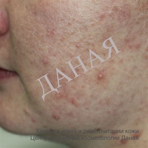 Акне (угри, прыщи)
