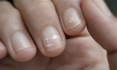 White stripes on your nails - what does that mean? - Earth.com