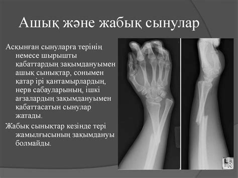 Жарақаттар (буынның шығуы, сынық) - презентация онлайн