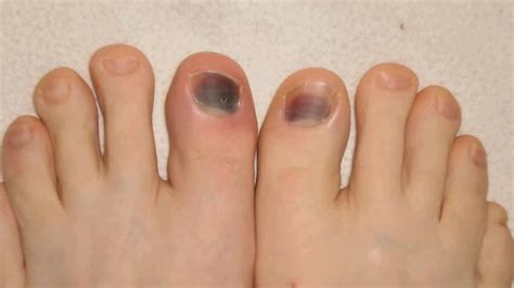 Why Is My Toenail Growing Inward at Shaun Henderson blog