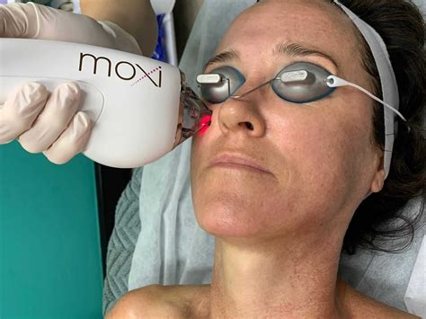 Moxi Laser by Sciton | City Laser Clinic Sydney