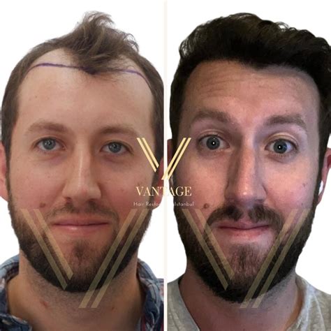 Hair Transplant for Receding Hairline | Norwood Scale | 2024 Costs