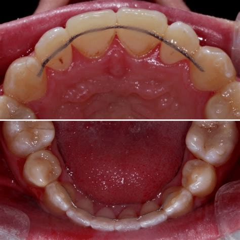 Banded Retainer