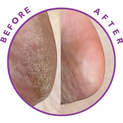 Revitalizing Foot Peel Mask - Reboot™ – Barefoot Scientist