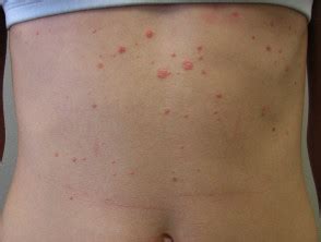Psoriasis - Guttate - Patient Education