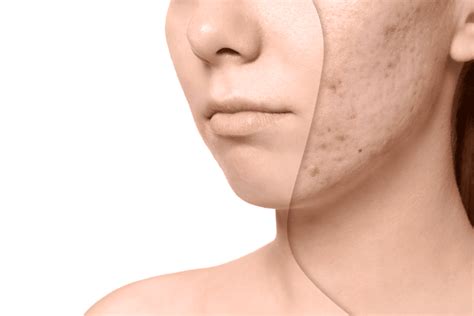 Acne Scars – What are my Treatment Options? - Northstar Dermatology