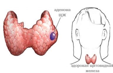 Т3 свободный повышен: что значит, каковы причины и патологии