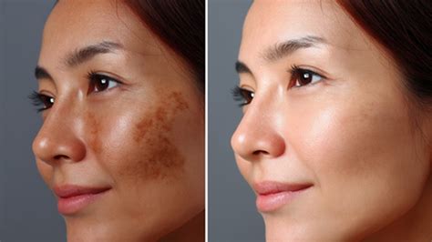 remove spots troubled  blemishes   face learn
