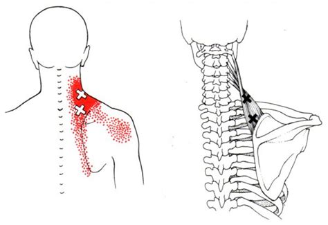 Scapular Dyskinesia: an often neglected cause of Neck Pain | Active ...