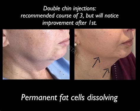 how to get rid of fat under chin 5