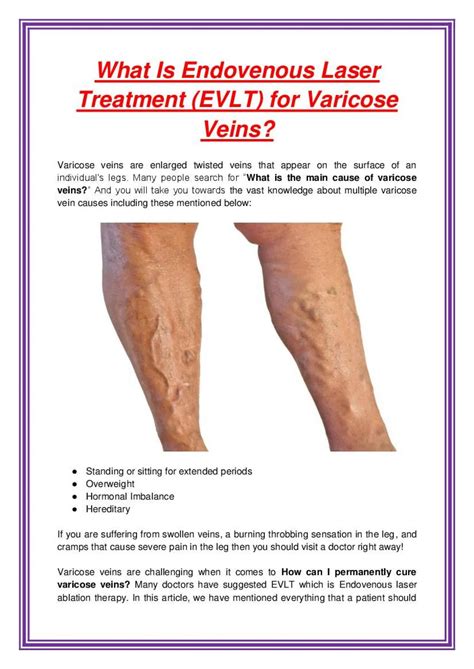 PDF-What Is Endovenous Laser Treatment (EVLT) for Varicose Veins?