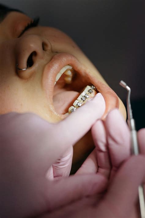 Braces Photos, Download The BEST Free Braces Stock Photos & HD Images
