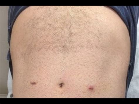 Laparoscopic Inguinal Hernia Repair Scars