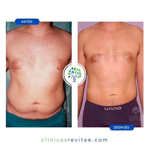 Faloplastia Antes E Depois Aumento Fotos