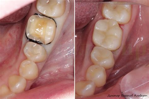 CEREC. Керамическая накладка On-Lay за два часа | Стоматология Dентал Мир
