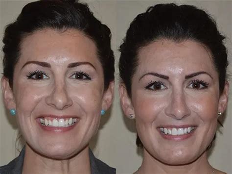 Cosmetic Injectables and Fillers Before and After Pictures Case 1050