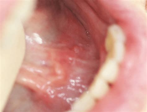 Diffuse, firm, palpable swelling across the sublingual folds ...