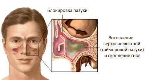 Гайморит - симптомы, диагностика, лечение — медцентр Аксис (Зеленоград)