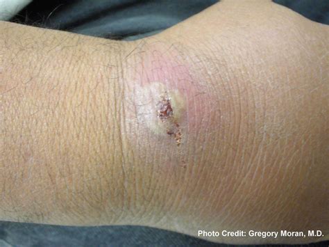 Mrsa On Finger