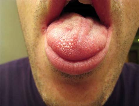 Red or White Bumps on Back of Tongue, Tip & Sides-Causes & Remedies